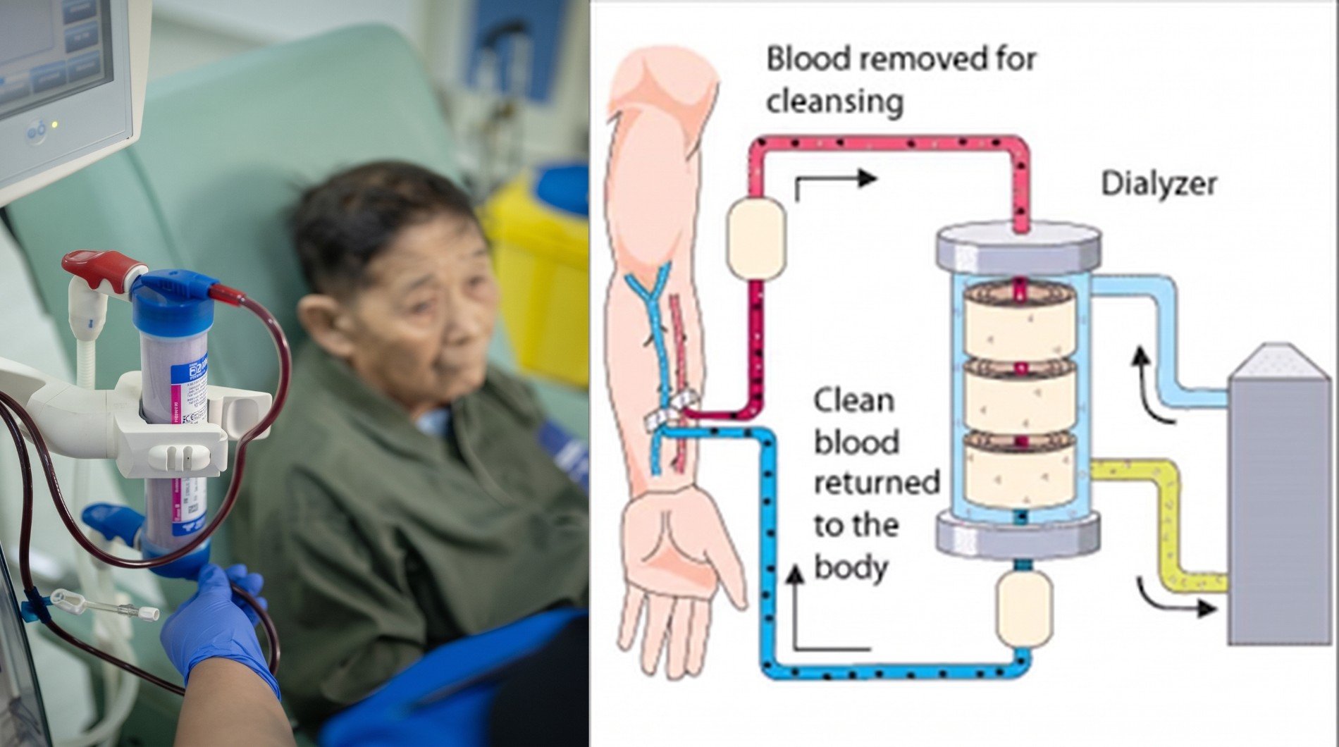 Haemodialysis: What It Is and What to Expect