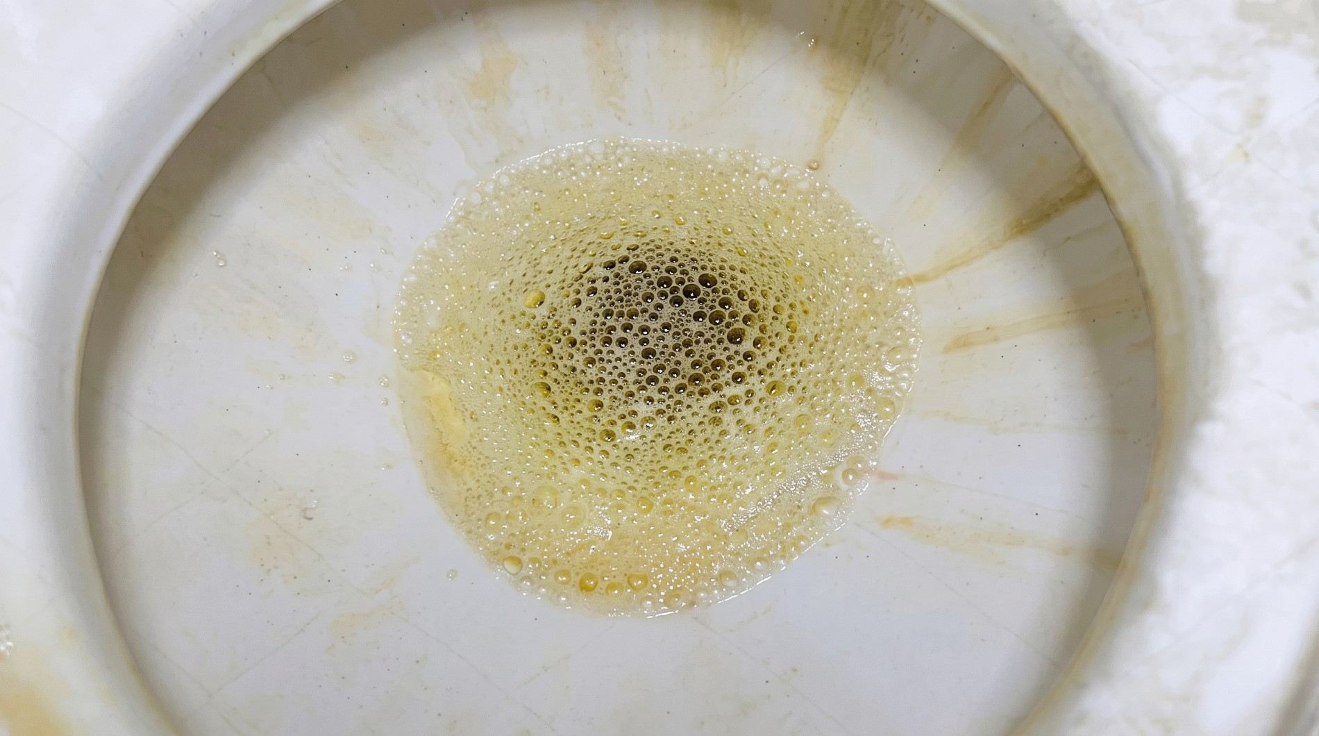 Proteinuria: Causes, Symptoms, Diagnosis and Treatment